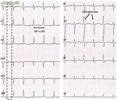 Ectopic Atrial Tachycardia in a 12-Month-Old Girl Treated With Ivabradine and Beta-Blocker, a Case Report